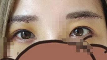 切眉后图片,焕新容颜——切眉术后美丽蜕变记